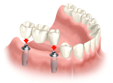 Image for Dental  Implant with ID of: 714095