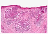 Image for Skin cancer procedure with ID of: 822198
