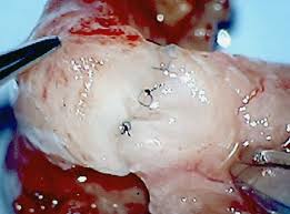 Image for Microscopic Vasectomy Reversals with ID of: 903874