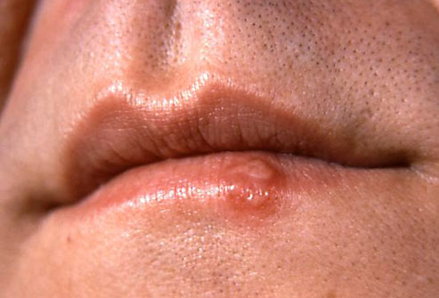 Image for Preventing Cold Sores with ID of: 999267