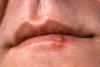 Photo for Preventing Cold Sores