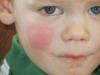 Photo for Treatment Of Urticaria