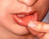 Photo for Cures For Cold Sores