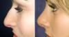 Photo for Rhinoplasty Nose Surgery Nevada USA
