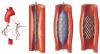 Photo for China Coronary Stents Market 2015 Industry Trends and Forecast to 2020