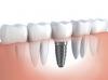 Photo for China Dental Market 2015 Industry Trend, Share, Opportunities and Forecast to 2020