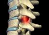 Photo for Spine Surgery Cost in India
