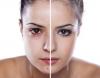 Photo for Most effective acne treatment