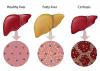 Photo for Global Nonalcoholic Steatohepatitis Market Analysis and Forecast, 2014 – 2020.