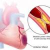 Photo for Chronic Stable Angina Clinical Trials Review 2016 By Global Market Research Store