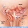 Photo for Inguinal Hernia Clinical Trials Review 2016 By Global Market Research Store