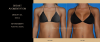 Photo for breast augmentation Chicago