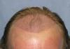 Photo for Hair Transplant In Dubai