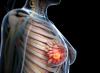 Photo for Global Cancer Diagnostics Market Set for Rapid Growth, To Reach Around USD 128.6 Billion by 2020