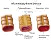 Photo for Ulcerative Colitis Therapeutics Market to Grow,thanks to Strong Pipeline of Therapeutic Products