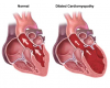 Photo for Global Market for Dilated Cardiomyopathy Therapeutics to Exhibit -7% CAGR from 2014 to 2020 due to Easy Availability of Implantable Devices