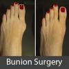 Photo for Get Rid Of That Painful Toes With Bunion Surgery