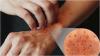 Photo for Global Pruritus Therapeutics Market analysis and Value Chain 2015 - 2020