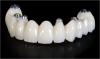 Photo for Global Dental Implants and Prosthetics Industry Sales and Revenue Forecasts 2015-2022 – Value Chain Analysis, key market players and its profile