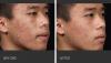 Photo for Acne Vulgaris Treatment Market - Global Industry Perspective, Comprehensive Analysis and Forecast, 2014 – 2020