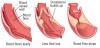 Photo for Hypercholesterolemia Market size and Key Trends in terms of volume and value 2014-2020