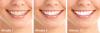 Photo for What is White Light Smile&its Uses?