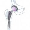 Photo for Global Hip articular Prostheses Market Analysis, Share & Application 2016