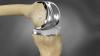 Photo for Global Knee joint prosthesis Market Analysis, News & Share 2016