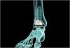 Photo for Global Total Ankle Replacement Industry 2016 Trends, News & Growth