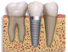 Photo for Dental implants | Vsmile Dental, NJ