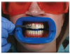 Photo for Tooth filling - White Fillings & Dental Bonding