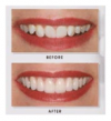 Photo for Veneers dentist | Dental veneers | Vsmile Dental, NJ