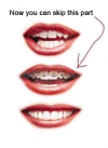 Photo for Invisalign - Invisalign Procedure, Advantages & Disadvantages