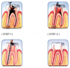 Photo for Root Canal - Root Canals Procedure for Infected Tooth Nerve