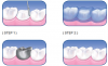Photo for Dental crown bridge | Vsmile Dental Princeton Junction,NJ