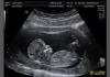Photo for Global Ultrasound Market is Expected to Cross USD 6.90 Billion by 2021