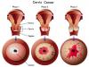 Photo for cervical cancer diagnostics market segment forecast 2015-2021