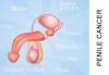 Photo for Penile Cancer Market - Global Industry Analysis, Size, Share, Growth, Trends and Forecast 2015 - 2021