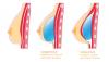 Photo for Breast Augmentation, Enlargement and Implants in London, UK