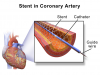 Photo for Coronary Stents Market Analysis, Strategies & Growth 2021