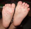 Photo for Presence of Government-funded Entities in Foot and Mouth Disease (FMD) Vaccines Market Compels Private Players to Innovate
