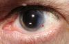 Photo for Ophthalmology Cataract Surgery Devices: A Revolutionary innovation that redefines HC for Healthier Future