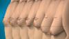 Photo for Gynecomastia Surgery London