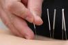 Photo for Global Acupuncture Needle Market analysis and forecast from 2016-2021
