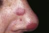 Photo for Patent Expiry of Blockbuster Drugs for Treatment of Kaposi Sarcoma to Present Lucrative Opportunities, says TMR