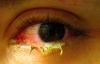 Photo for Growing Demand for Targeted Viral Conjunctivitis Drugs Compels Drugmakers to Formulate Aggressive Research Strategies, observes TMR