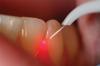 Photo for Oral Cavity Laser Therapeutic Apparatus Production Market Share Analysis 2016