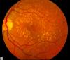 Photo for Wet Macular Degeneration Market: Technological advancements in diagnosis of macular degeneration is driving the growth of the market