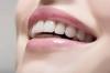 Photo for SoleilGLO Tooth Whitening System – Make your smile more confidence!