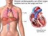 Photo for Global Dilated Cardiomyopathy Market Research Report 2016